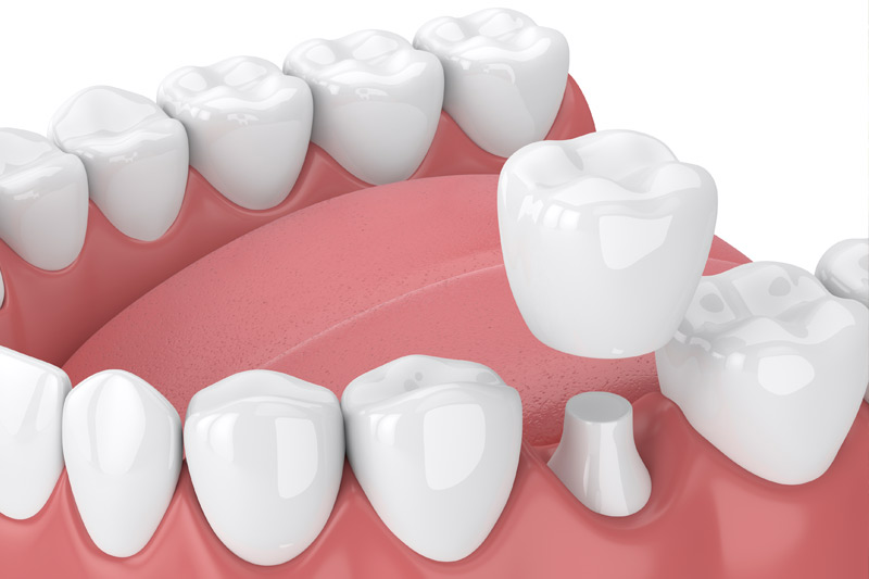 Dental Crowns in Baytown