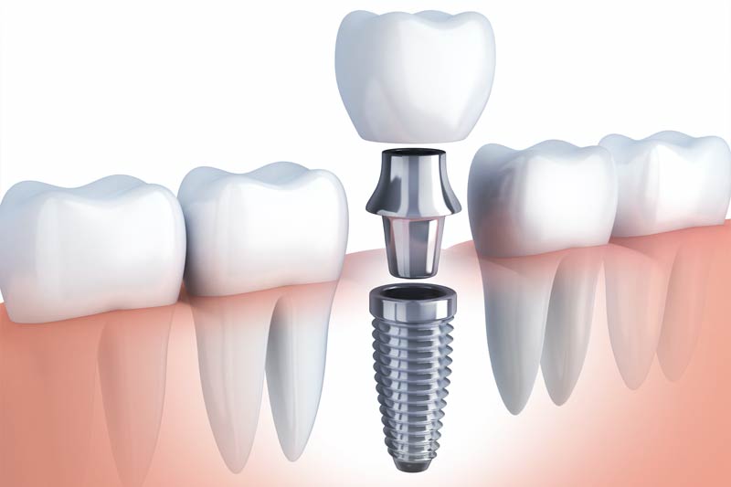 Implants Dentist in Baytown