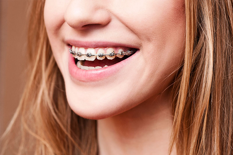 Orthodontics in Baytown