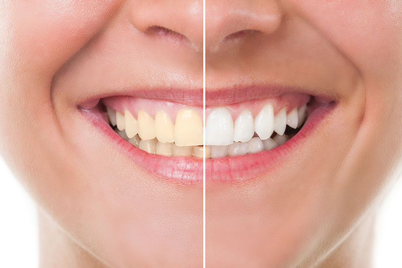 Teeth Whitening in Baytown