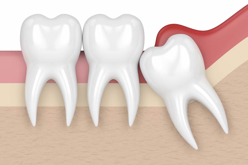 Wisdom Tooth Removal in Baytown